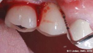 Figure 6: Preoperative bone sounding (under local anesthesia) was needed to determine the bone topography