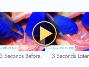 fast infant frenectomy baxter