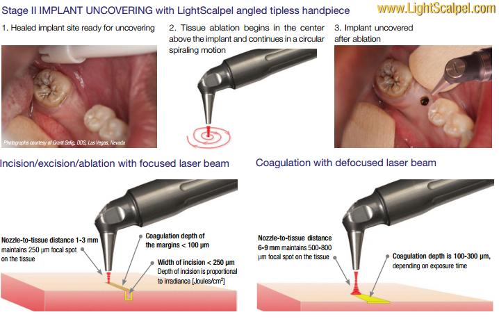 CO2 dental laser graphics