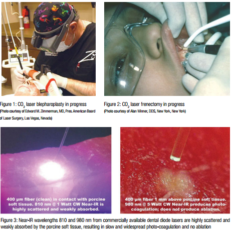 CO2 laser surgeries and dental diodes