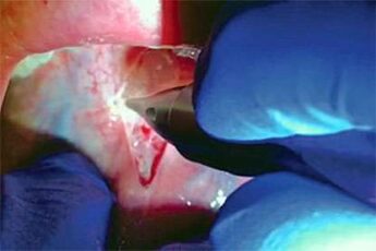 functional laser frenectomy