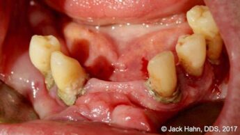 hypertrophy tissue removal with laser 1