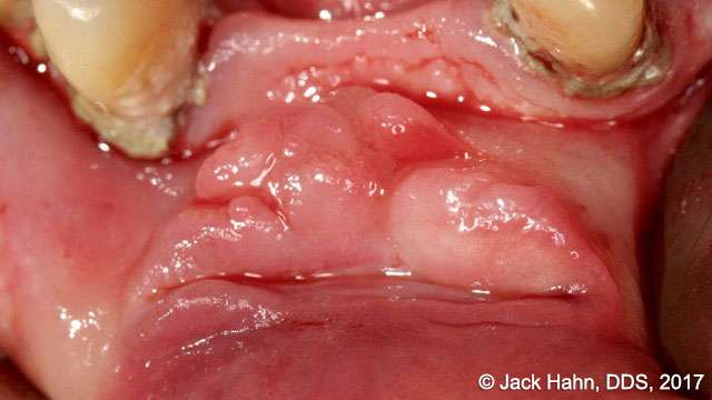 hypertrophy tissue removal with laser 2