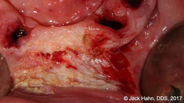 hypertrophy tissue removal with laser 3