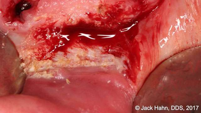 hypertrophy tissue removal with laser 4