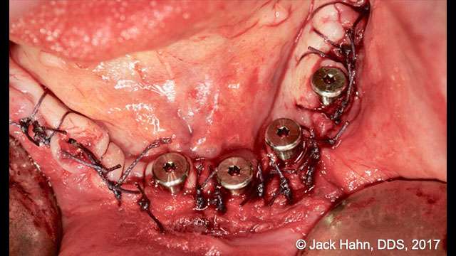 hypertrophy tissue removal with laser 5