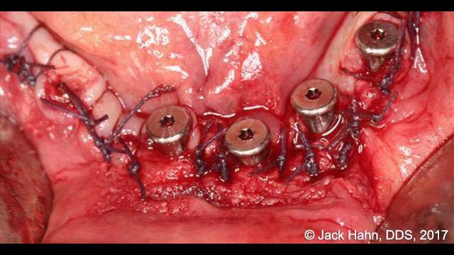 hypertrophy tissue removal with laser 6