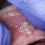 Lip Tie 7 days later