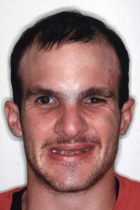 implant reconstruction 01 pre-op full face 2