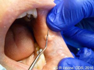 patient presented with a raised, round, circumscribed lesion on the left buccal mucosa