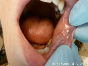 Fourteen days after surgery