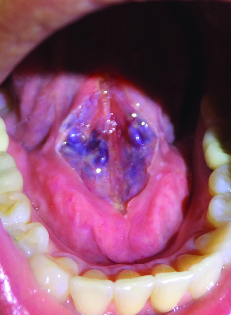 Surgical site immediately after a lingual CO2 laser frenectomy