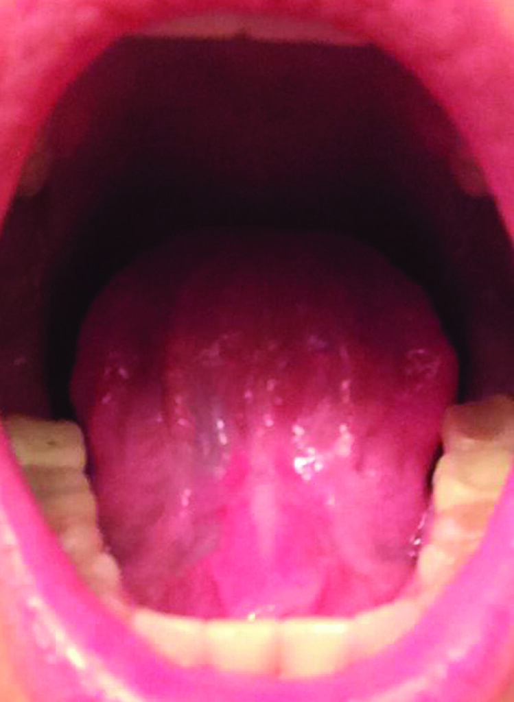 Completely healed, scar-free tongue 4 weeks after