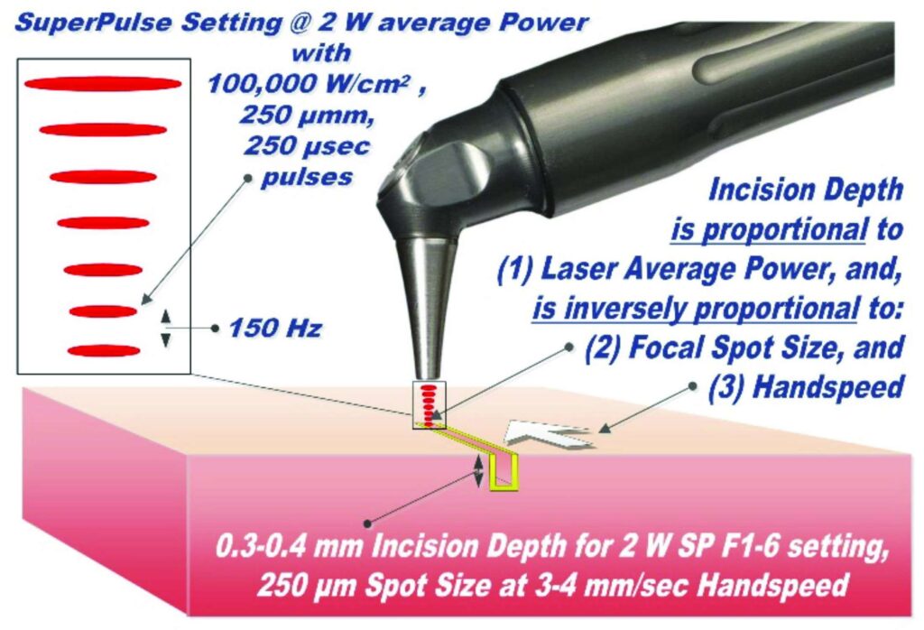 Laser-tissue incision with focused laser beam