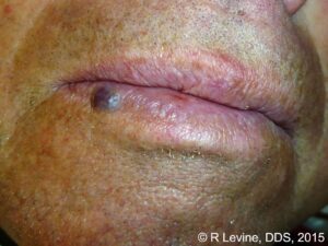 capillary hemangioma of the lip
