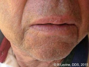 laser hemangioma post op