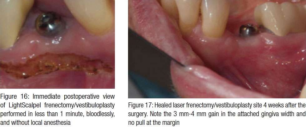 laser implant tissue tension 16-17