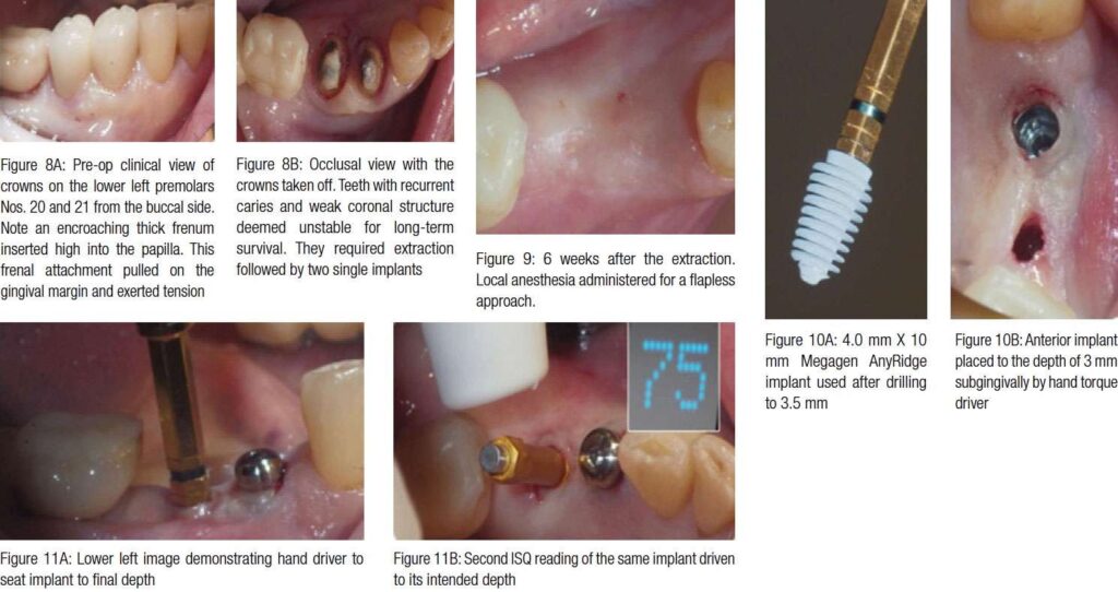 laser implant tissue tension 8a-11b