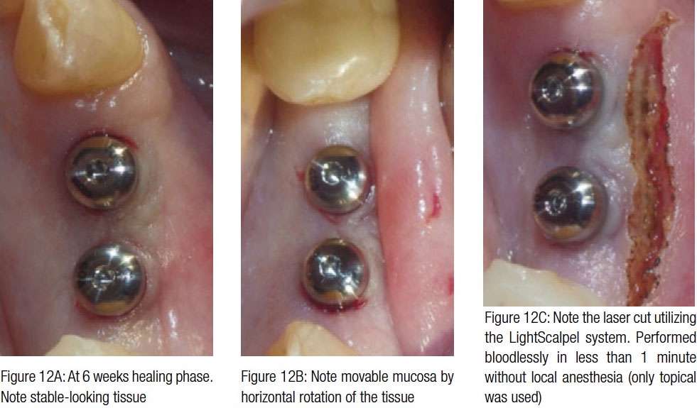 laser implant tissue tension12a-12c
