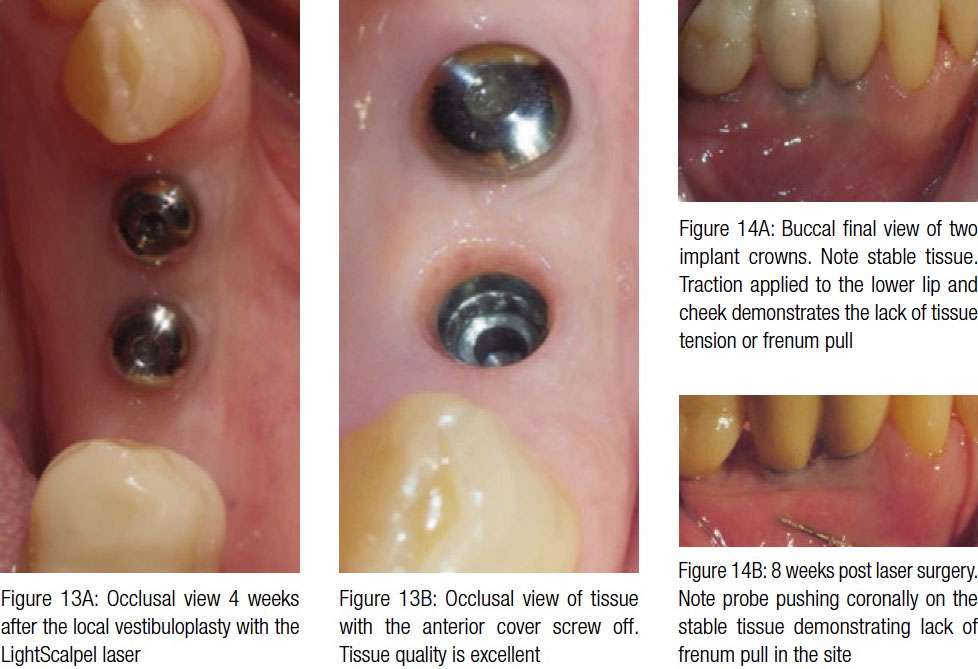 laser implant tissue tension13a-13b