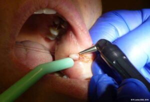 Laser Irritation Fibroma