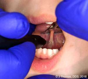 LightScalpel CO2 Laser Lingual Frenectomy