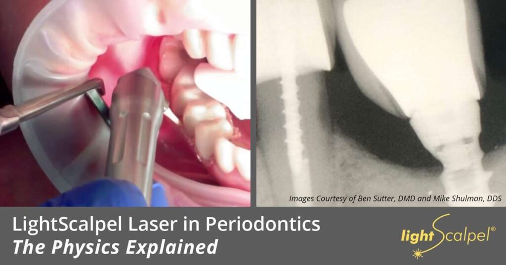 laser periodontics