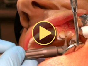laser uses in dentistry