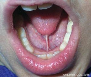 lingual frenectomy before