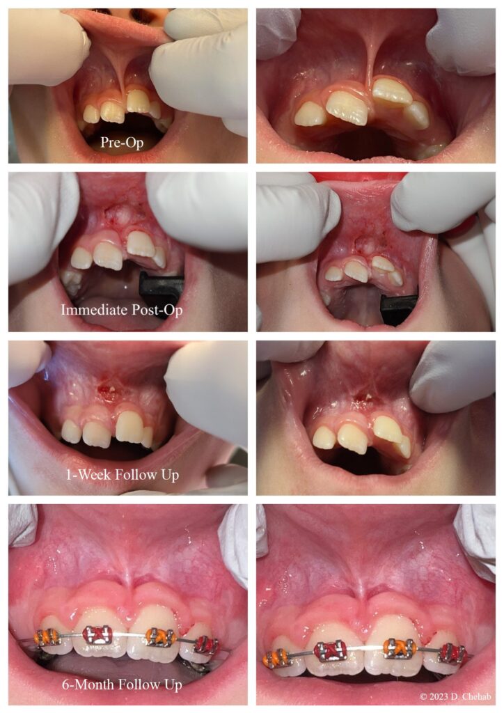 Lip-Tie Release Results and Healing with LightScalpel CO2 laser
