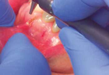 Oral CO2 laser surgery Footage