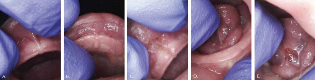 fig 1 infant tongue- and lip-ties