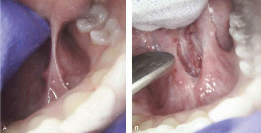 fig 2 - autistic child tongue-tie