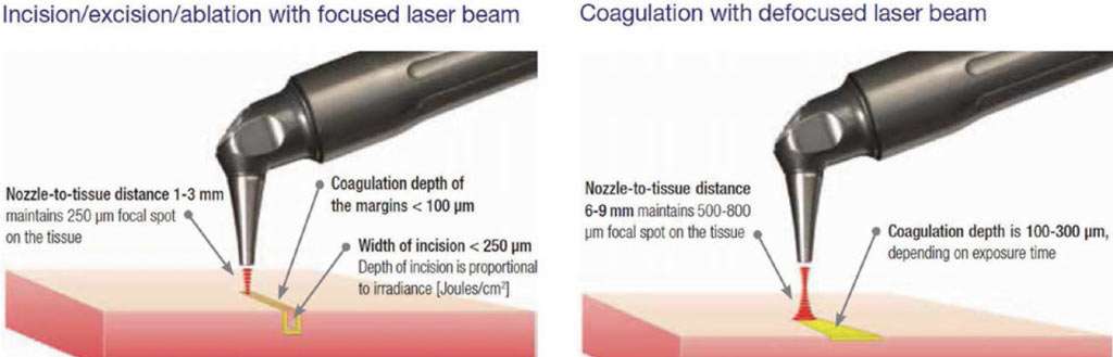Laser handpiece distance for cutting and coagulating
