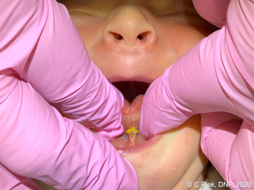 scissor tongue tie release