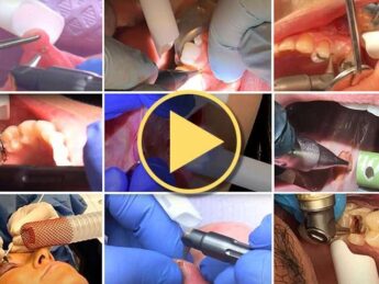 Laser Plume Smoke Evacuation