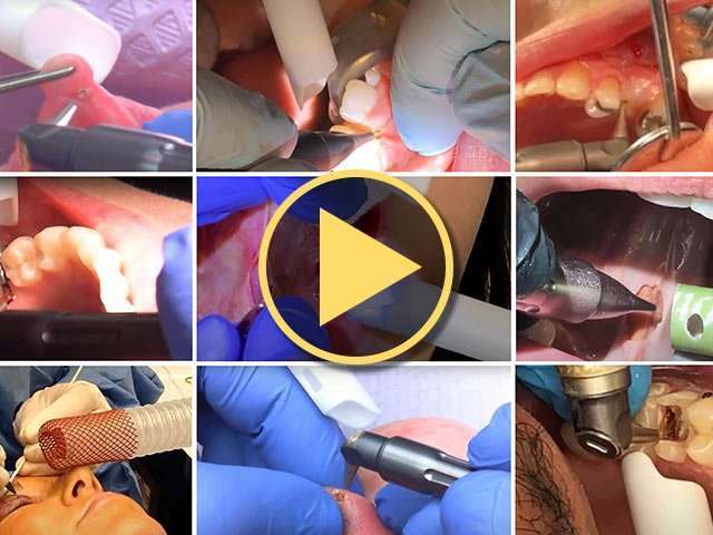 Laser Plume Smoke Evacuation