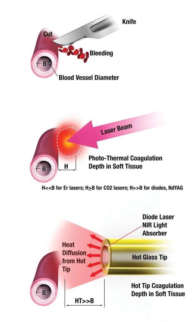 Coagulation and hemostasis mechanisms illustrated: none for scalpel; (b) photothermal coagulation inside irradiated soft tissue; and heat diffusion from the hot tip into the soft tissue.