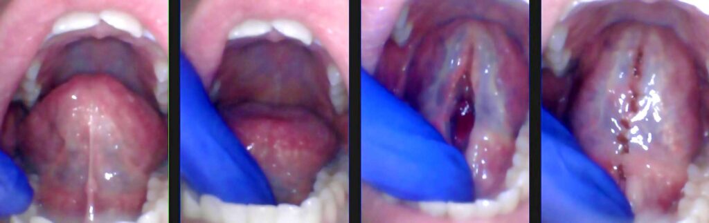 Figure 2: This is an opera singer who was restricted and was lifting her tongue