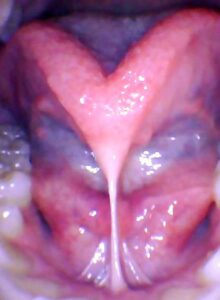 Tongue-Tie